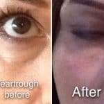 Tear Trough treatment before and after