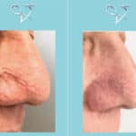 O.F.F. treatment for thread vein removal in the nose, before and after at Vie Aesthetics