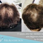 Thicker crown hair after 17 weeks of Regenera Activa