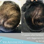 increased hair thickness after 17 weeks of Regenera Activa