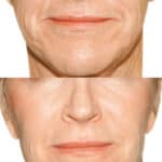 Results of Radiesse liquid facelift adding volume to lower face and nasolabial folds