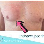 Endopeel pec lift for men at Vie Aesthetics