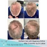 man with moderate hair loss shows the before and after results of Regenera Activa after 3 months