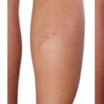 Microsclerotherapy for Spider or Thread Veins