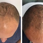 Five month results of Regenera Activa hair loss treatment