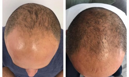 Halt your hair loss with Regenera Activa!