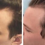 Young man shows thicker hairline after treatment