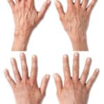 Results of Radiesse to add volume to ageing hands