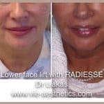 woman showing results of adiesse liquid facelift treatment for lower face