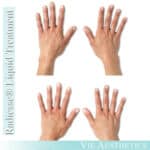 Results of Radiesse liquid treatment for ageing hands