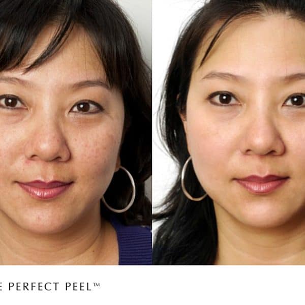 The Perfect Peel treatment before and after photo