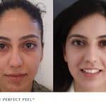 The Perfect Peel treatment before and after