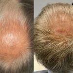 Results at 5-6 months after Regenera Activa treatment for thinning crown