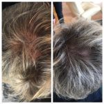 Middle-aged man shows thicker hair after Regenera Activa treatment at Vie