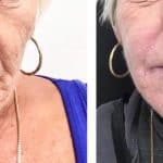 Woman in her 50s showing results of Perfect Peel, Ellanse and microneedling dermaroller treatments at Vie Aesthetics