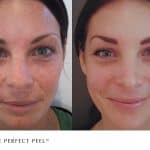 The Perfect Peel treatment for pigmentation