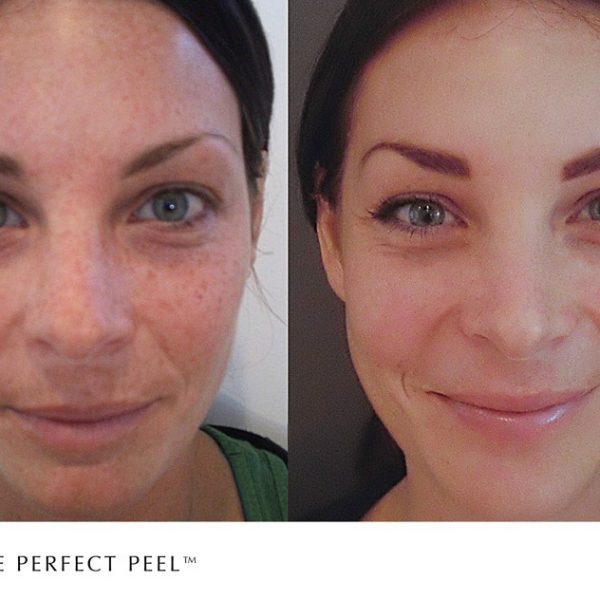 The Perfect Peel treatment for pigmentation