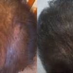 Improved hair thickness after PRP therapy