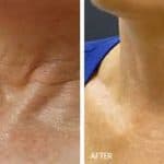 neck rejuvenation results after PRP treatment at Vie Aesthetics