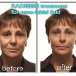 Results of Radiesse dermal filler for nasolabial folds