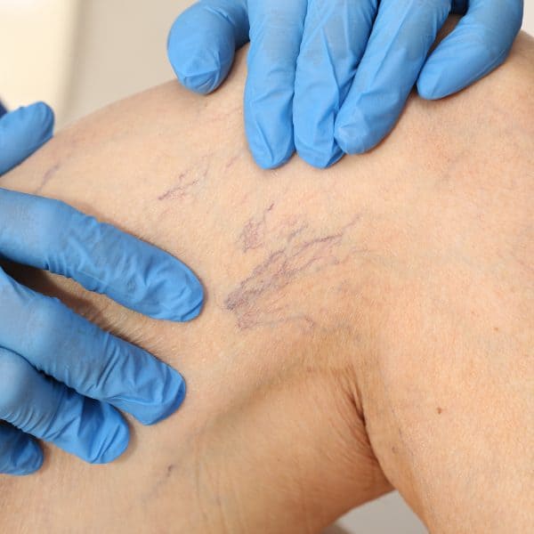 a person receives Microsclerotherapy treatment for Thread or Spider Veins in the leg