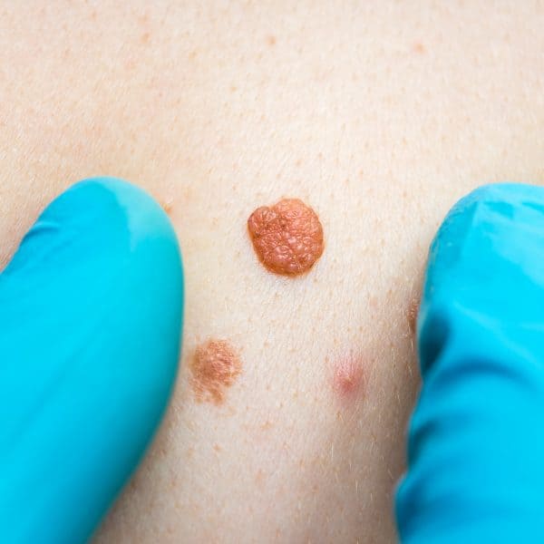 moles on a woman's back for removal with cryopen therapy