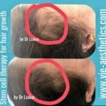 woman with female pattern baldness showing thicker hair after Regenera Activa treatment at Vie