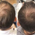 Man with thinning crown shows 3 months results after hair treatment