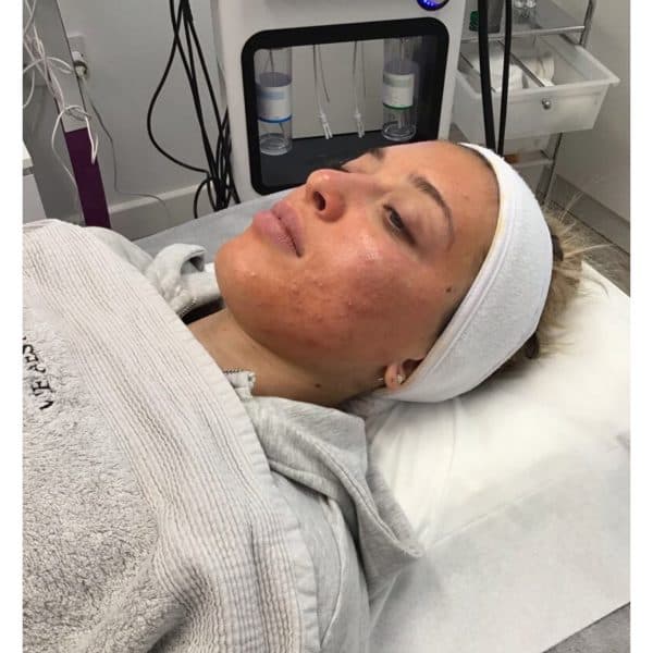 Anna during her Perfect Peel treatment at Vie Aesthetics