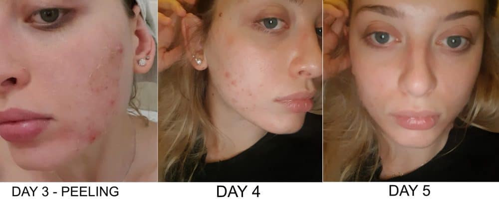 Skin peeling after Perfect Peel treatment during days 3 to 5