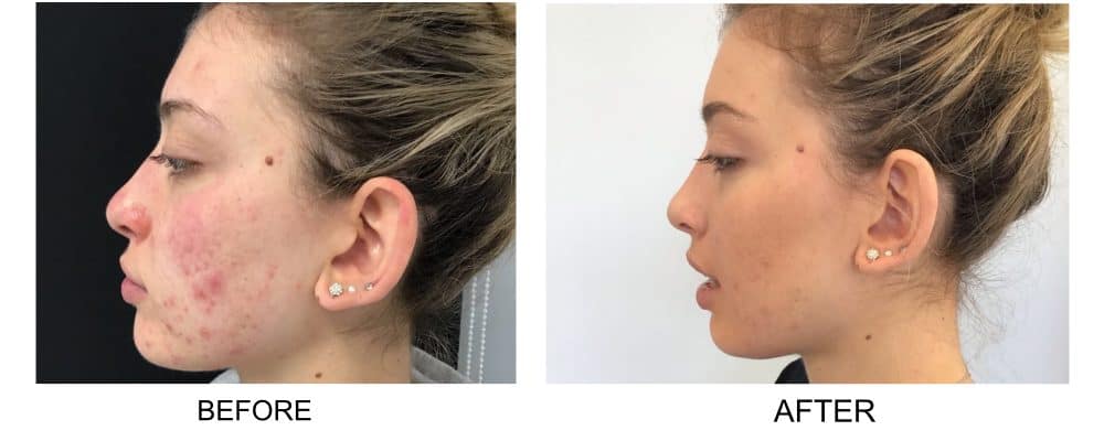 Anna's before and after photos following perfect peel treatment for acne