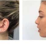 Anna's before and after photos following perfect peel treatment for acne