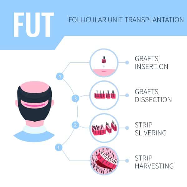 hair transplant diagram