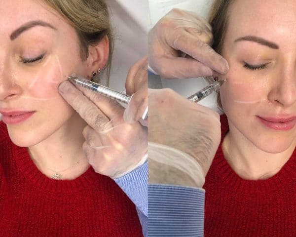 a woman has the Texas Jaw filler treatment