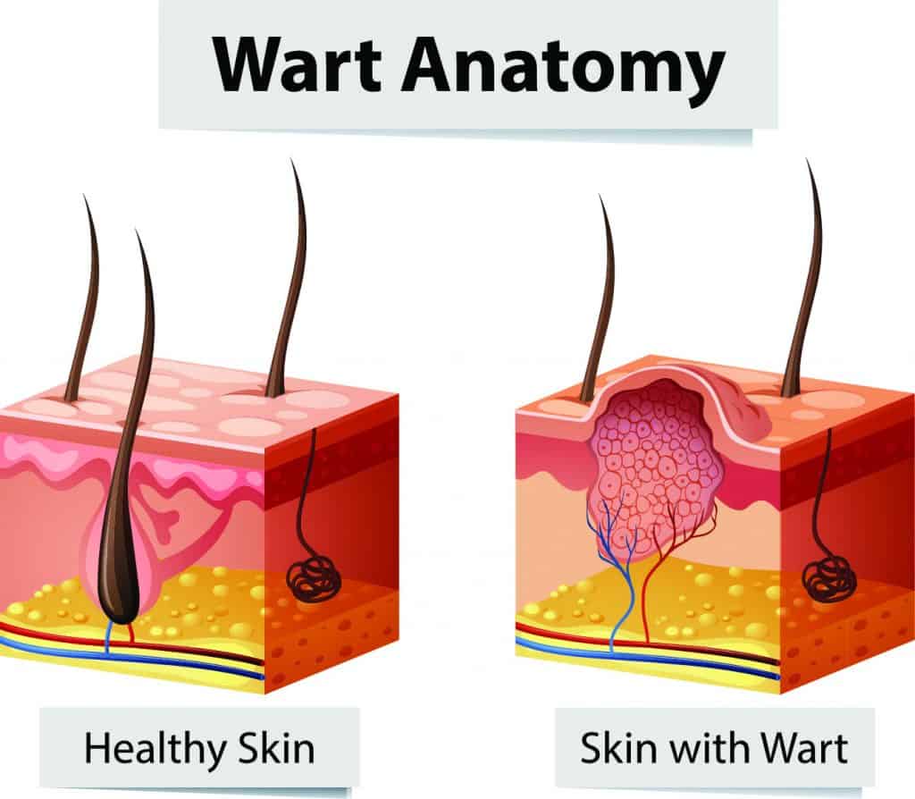 صف دراسي الحصى كومة wart skin tag - strengthflexibilitybalance.com