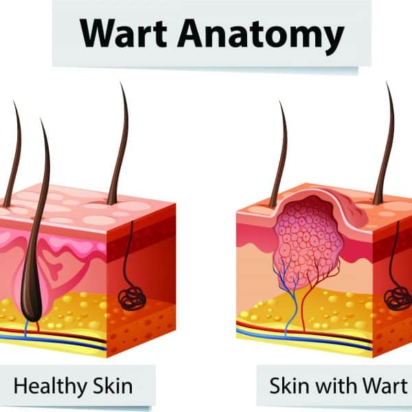 diagram showing the skin anatomy of a wart versus healthy skin