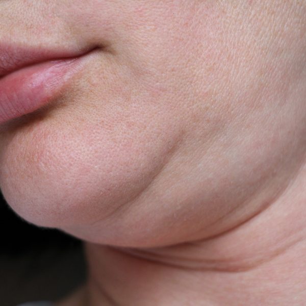 woman with a double chin considers a non-surgical fat reduction procedure