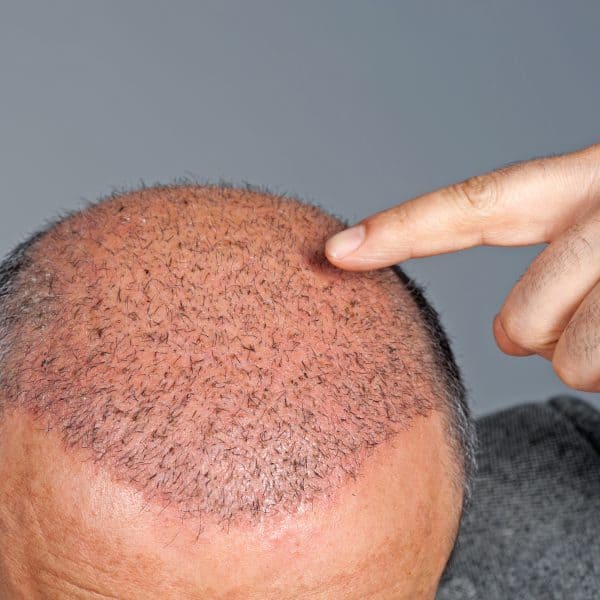 hair transplant after procedure