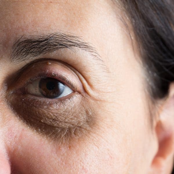 dark circles and eye bags on a middle-aged woman