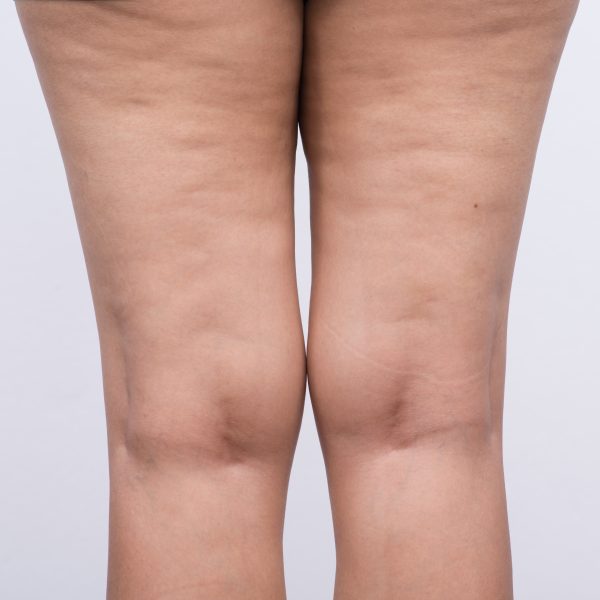 woman with cellulite on her legs