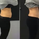 Woman after HIFU treatment for abdomen