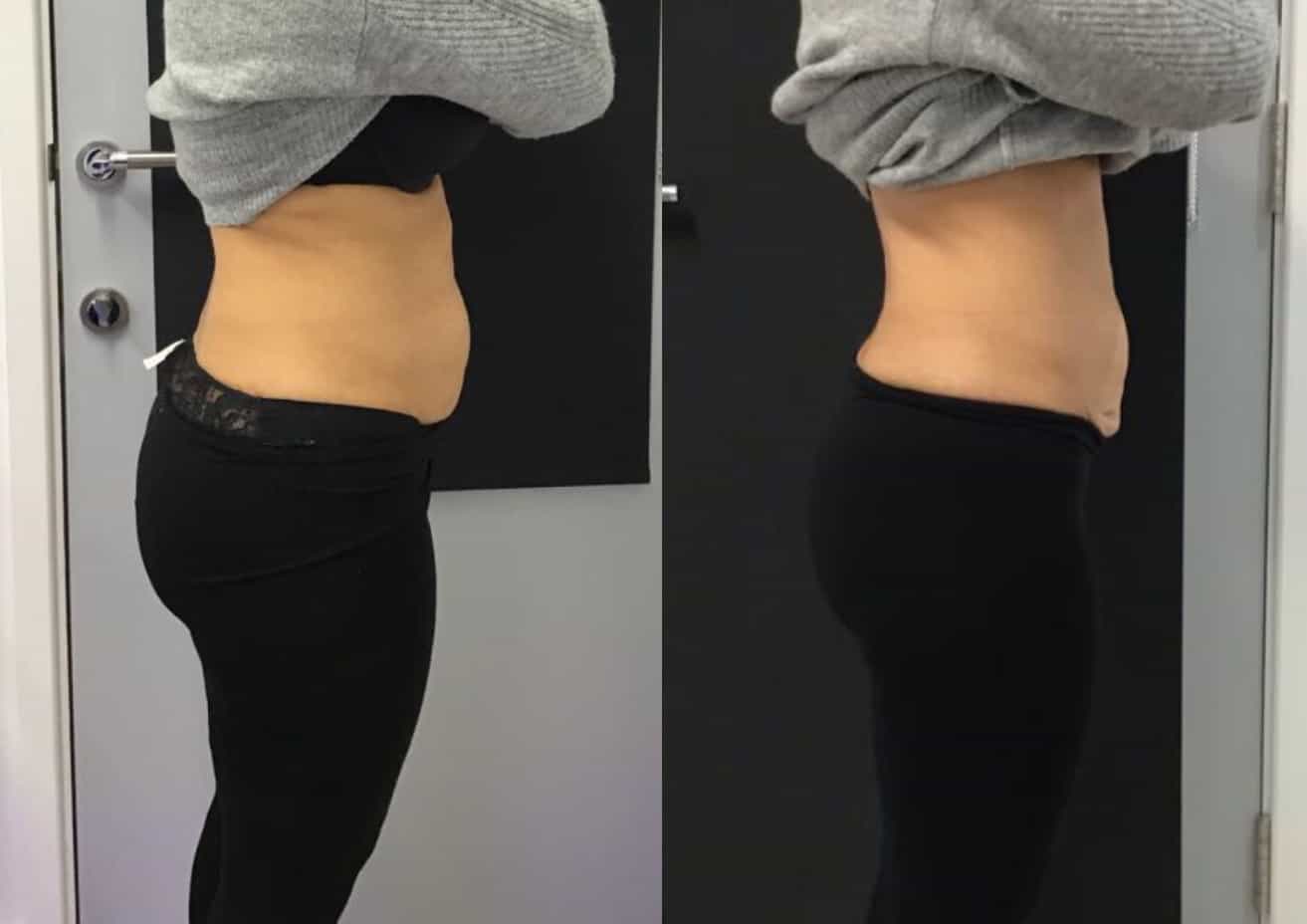 Woman after HIFU treatment for abdomen