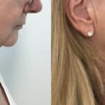 HIFU and Endopeel combination treatment for neck and jowls