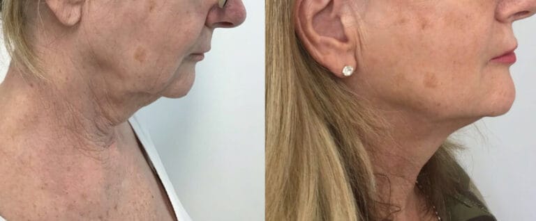 HIFU and Endopeel combination treatment for neck and jowls