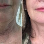 Results of HIFU and Endopeel combination treatment for neck and jowls