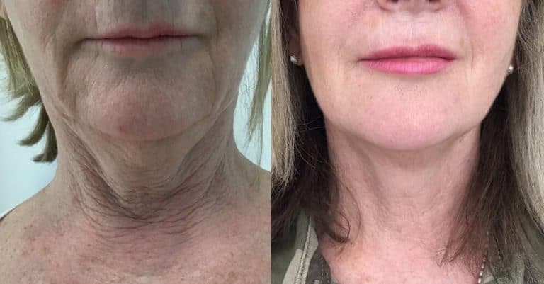 Results of HIFU and Endopeel combination treatment for neck and jowls