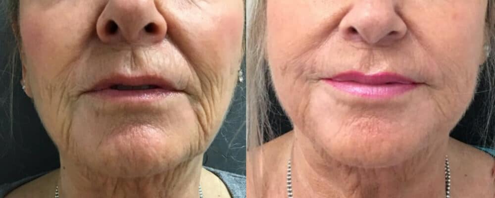 Middle-aged woman shows results of HIFU and Ellanse combination treatment for neck and lower face