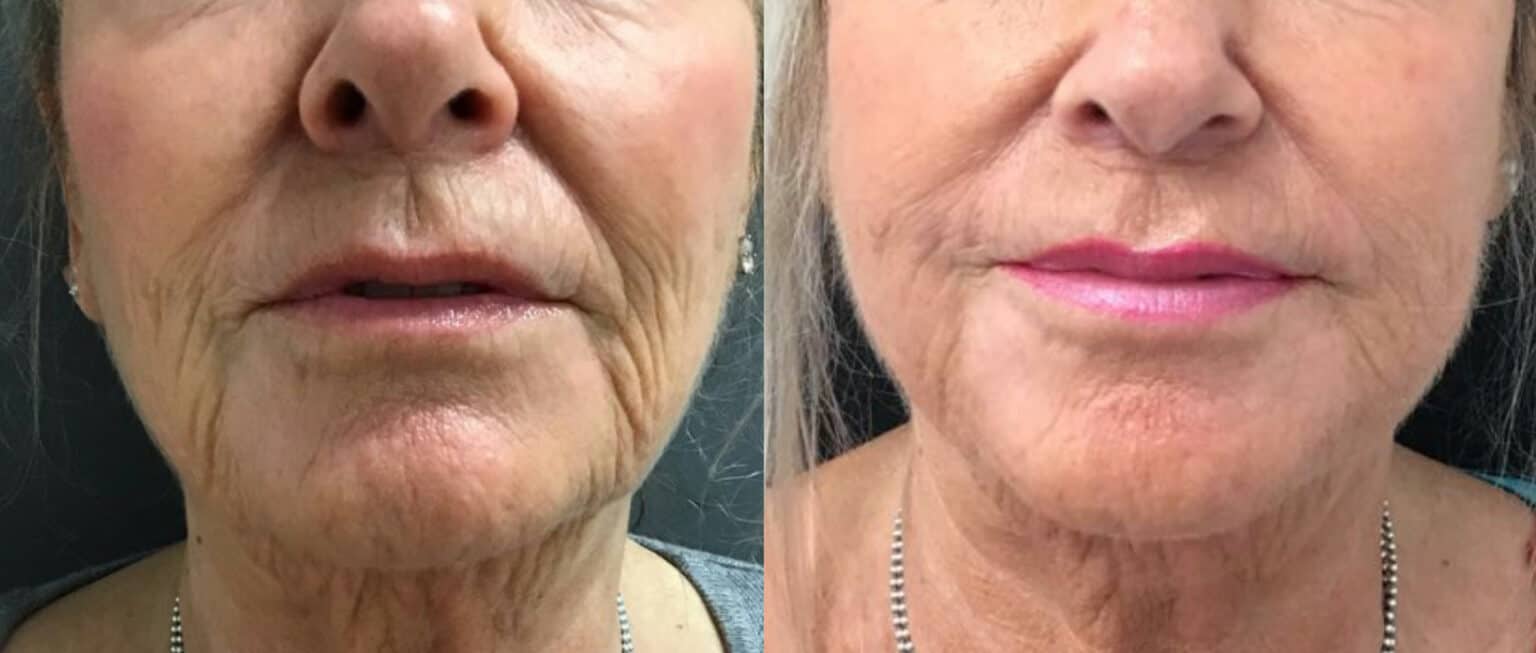 Middle-aged woman shows results of HIFU and Ellanse combination treatment for neck and lower face