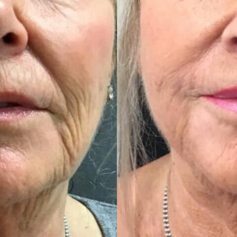 Middle-aged woman shows results of HIFU and Ellanse combination treatment for neck and lower face