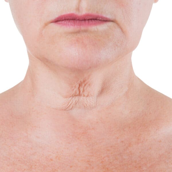 Neck (Loose Skin, Ageing)